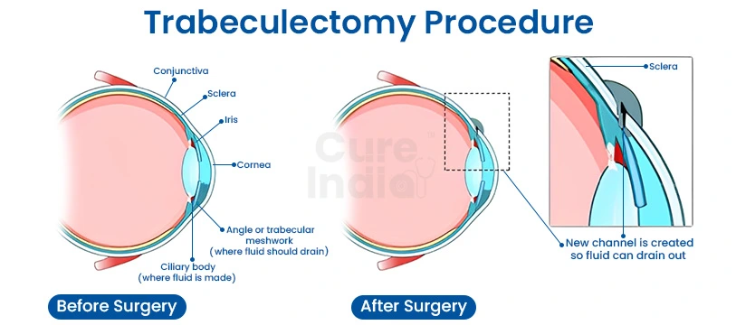 Trabeculectomy Surgery in India